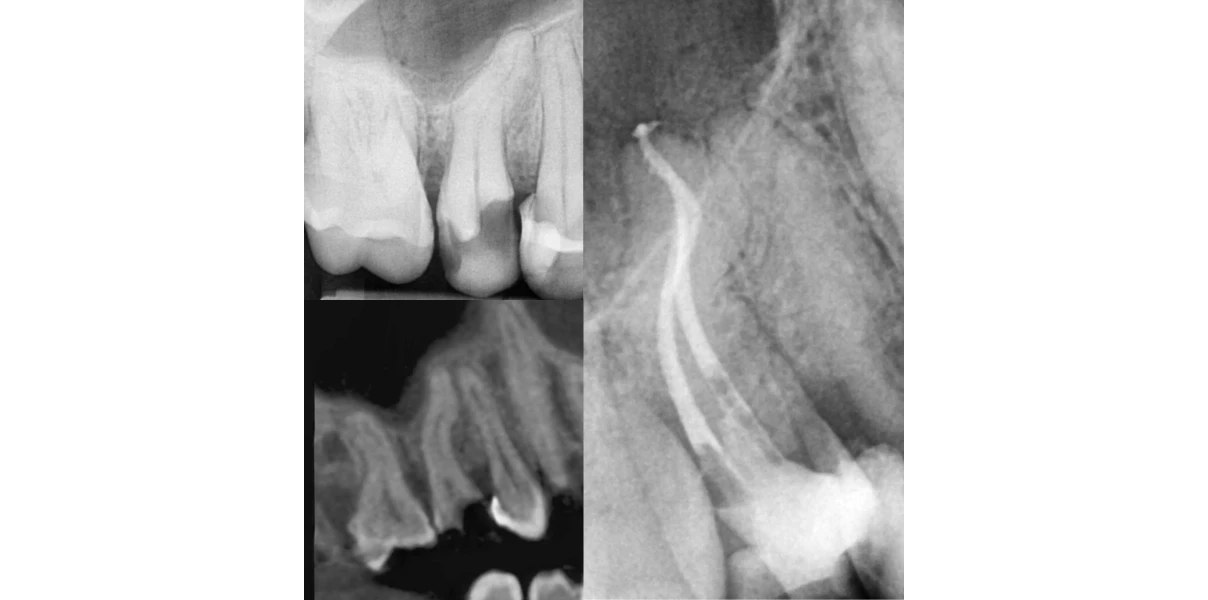 Cas cliniques au Cabinet d’endodontie du Dr Demetriou, endodontiste à Baisieux 59780