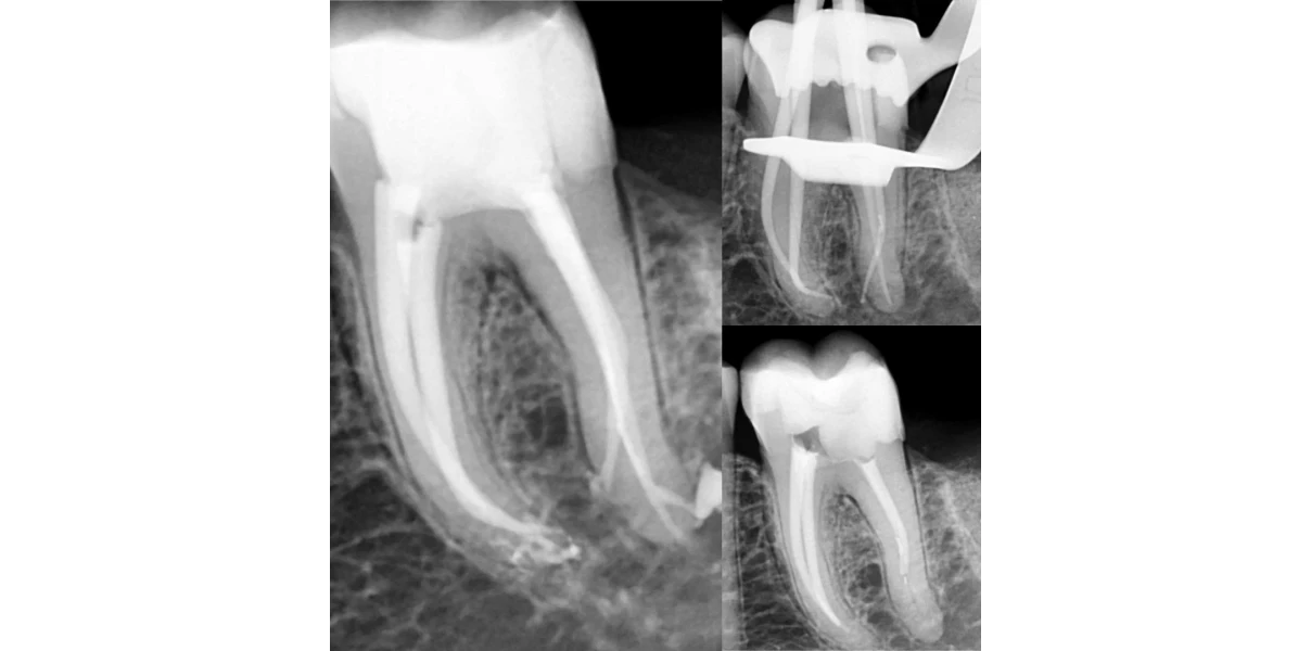 Le Docteur Demetriou, endodontiste exclusif à Baisieux 59780 : cas cliniques