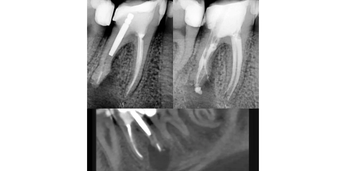 Cas cliniques au Cabinet d’endodontie du Dr Demetriou, endodontiste à Baisieux 59780