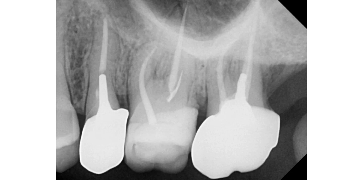 Retraitement endodontique au Cabinet d’endodontie du Dr Demetriou, endodontiste à Baisieux 59780