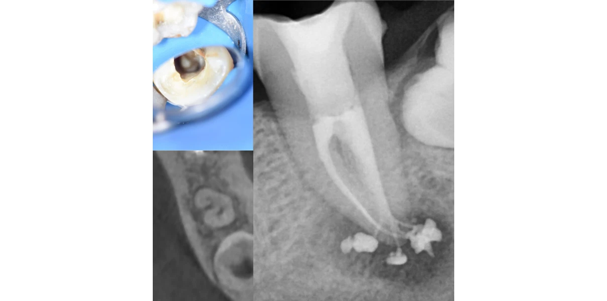 Le Docteur Demetriou, endodontiste exclusif à Baisieux 59780 : cas cliniques