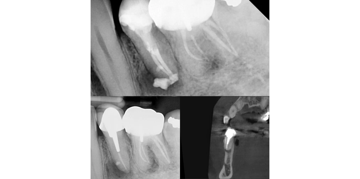 Canal non traité au Cabinet d’endodontie du Dr Demetriou