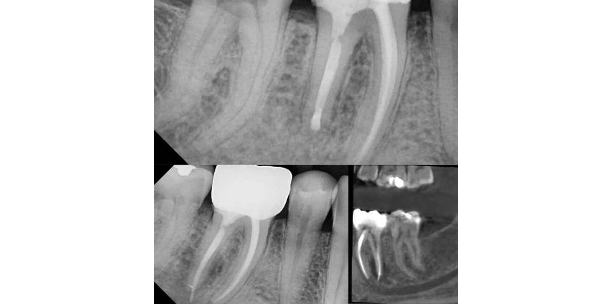 Le Docteur Demetriou, endodontiste exclusif à Baisieux : chirurgie endodontique