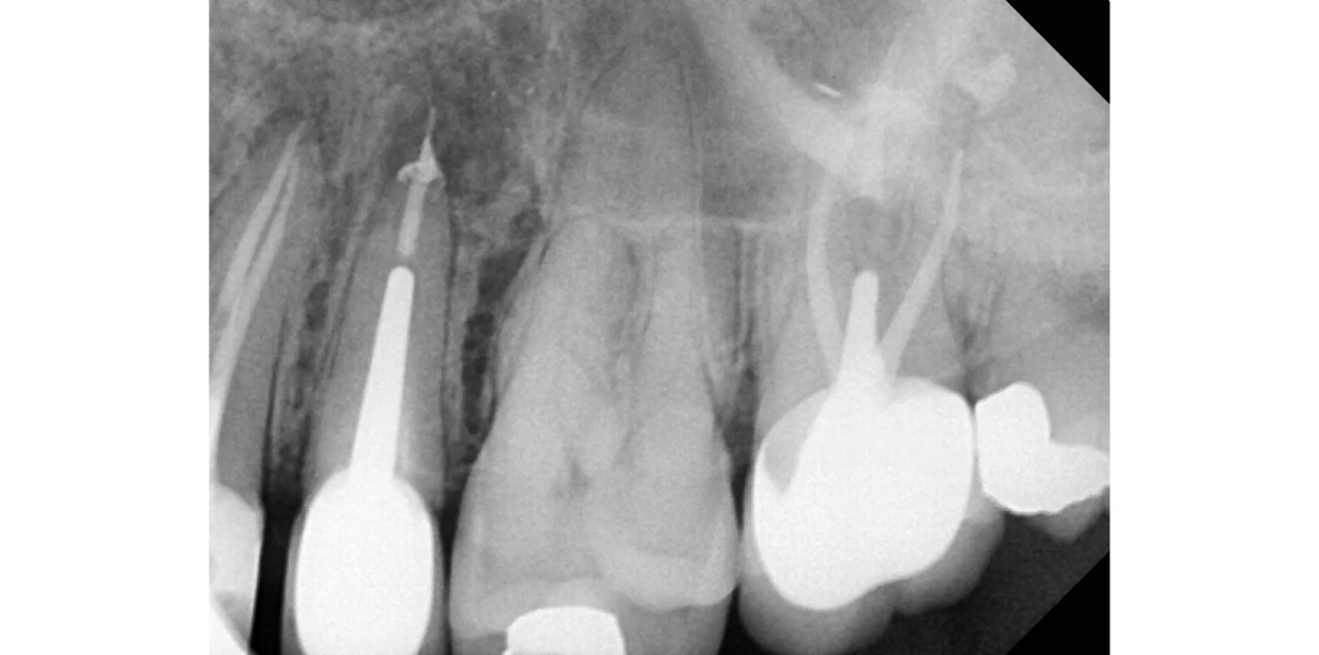 Chirurgie endodontique au Cabinet d’endodontie du Dr Demetriou, endodontiste à Baisieux 59780