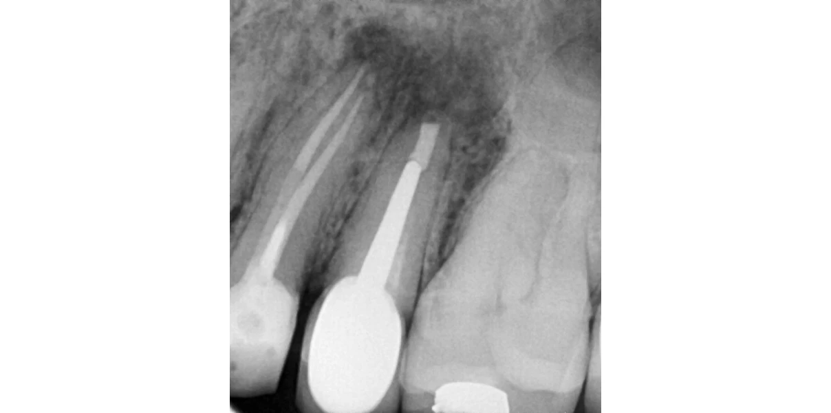 Le Docteur Demetriou, endodontiste exclusif à Baisieux : chirurgie endodontique