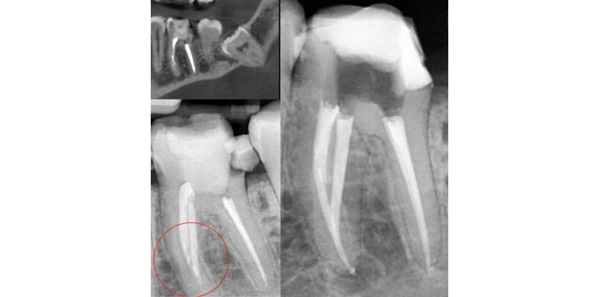 Debris instrumental au Cabinet d’endodontie du Dr Demetriou