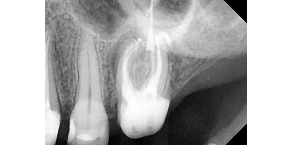 Le docteur Demetriou, endodontiste exclusif à Baisieux : démontage complexe