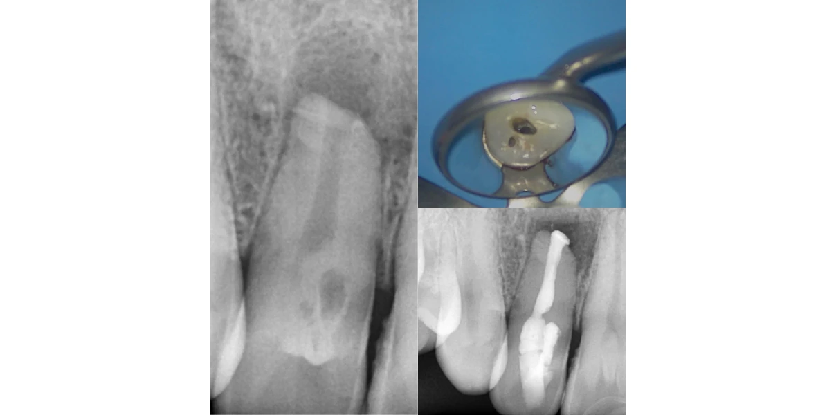 Cas cliniques au Cabinet d’endodontie du Dr Demetriou, endodontiste à Baisieux 59780