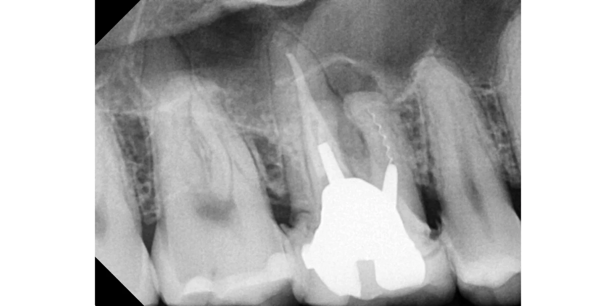 Le docteur Demetriou, endodontiste exclusif à Baisieux : cas cliniques