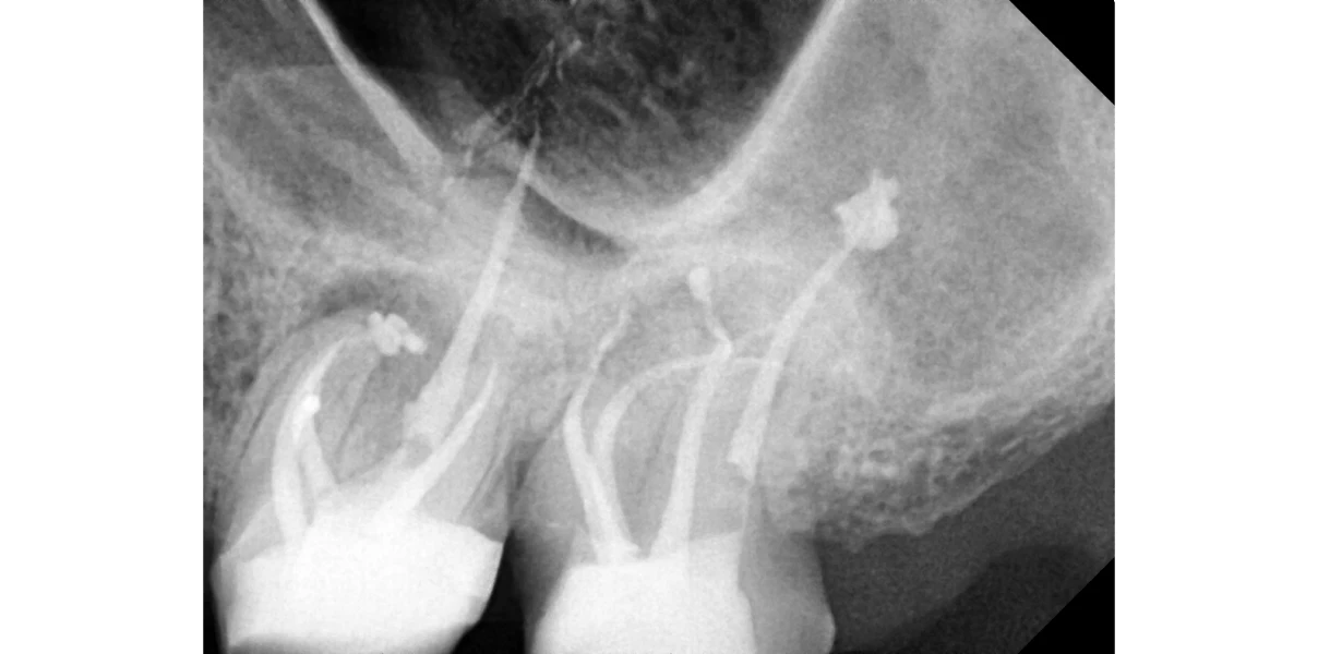 Cas cliniques au Cabinet d’endodontie du Dr Demetriou, endodontiste à Baisieux 59780