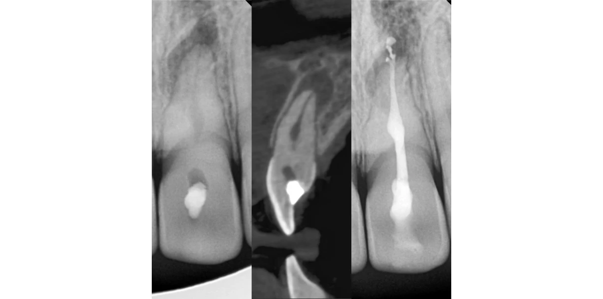 Le Docteur Demetriou, endodontiste exclusif à Baisieux 59780 : cas cliniques