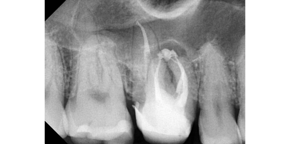 Cas cliniques au Cabinet d’endodontie du Dr Demetriou, endodontiste à Baisieux 59780