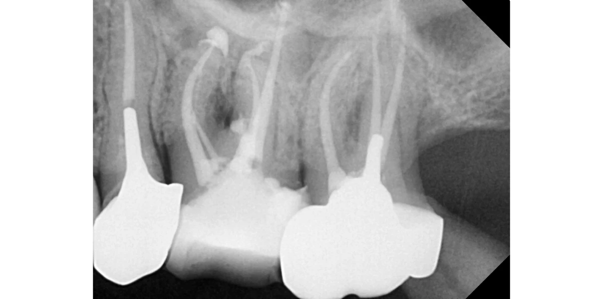 Le docteur Demetriou, endodontiste exclusif à Baisieux : cas cliniques