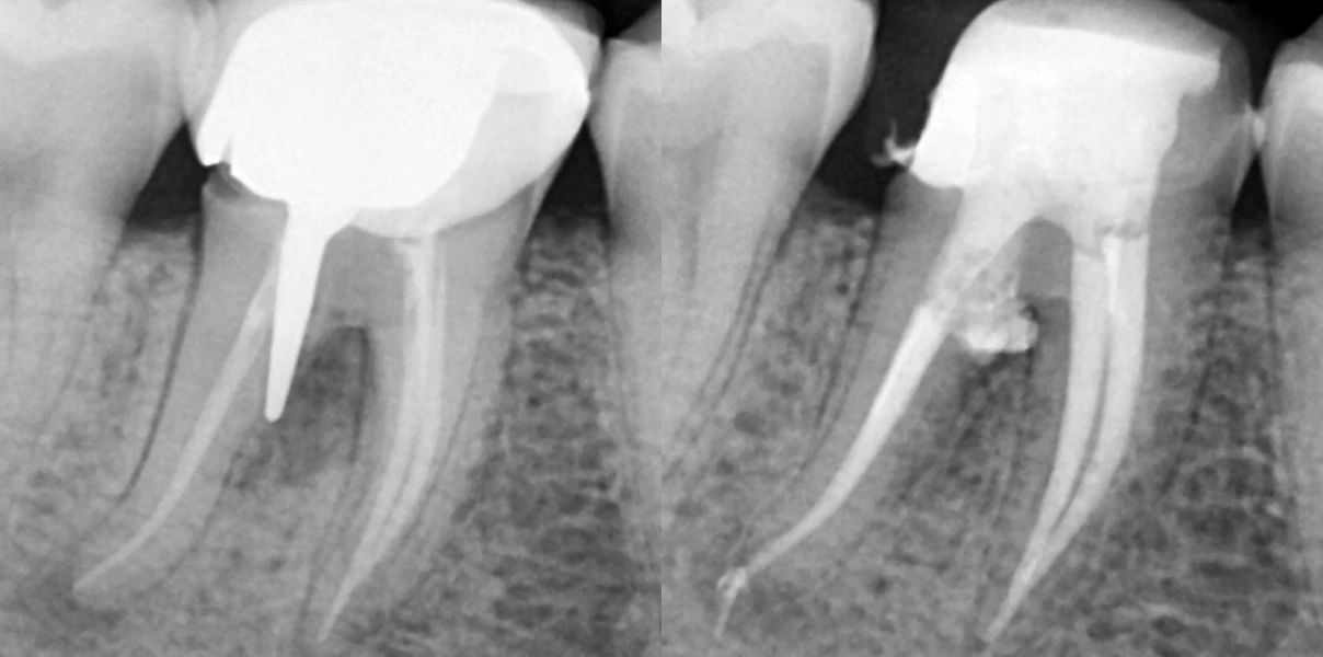 Perforation endodontique au Cabinet dentaire du Dr Demetriou, endodontiste à Baisieux 59780