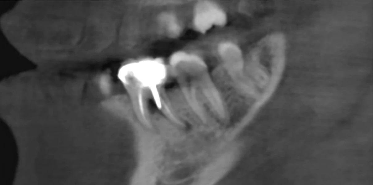 Perforation endodontique au Cabinet d’endodontie du Dr Demetriou, endodontiste à Baisieux 59780