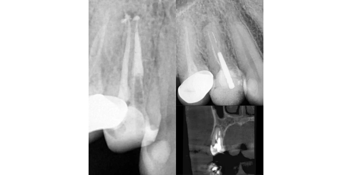 Le docteur Demetriou, endodontiste exclusif à Baisieux : cas cliniques