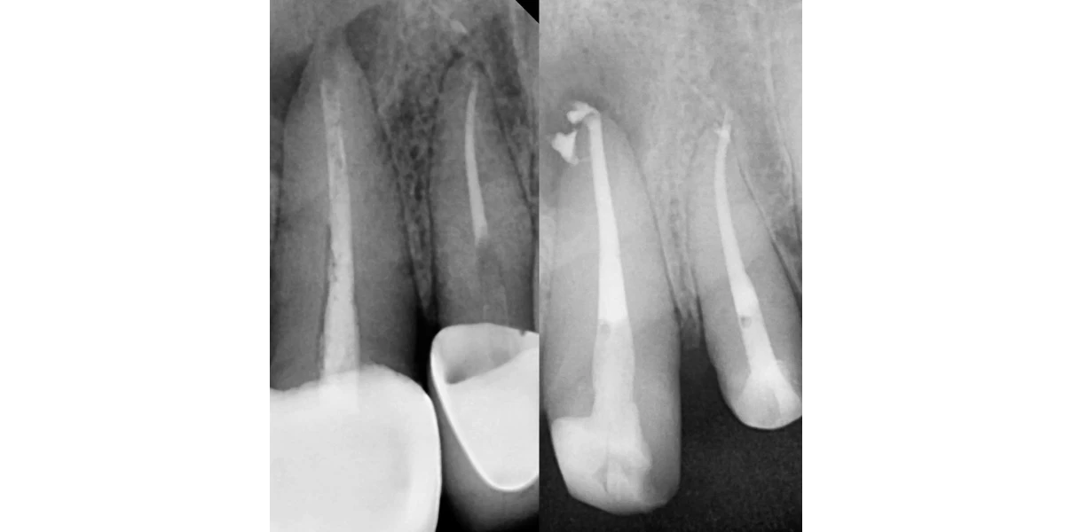 Retraitement endodontique au Cabinet dentaire du Docteur Alexandre Demetriou