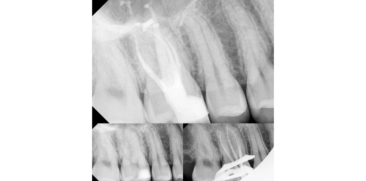 Traitement endodontique initial complexe au Cabinet d’endodontie du Dr Demetriou