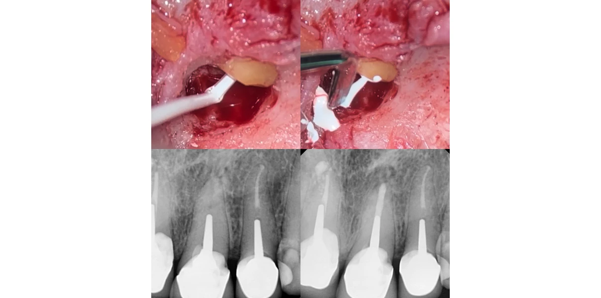 Cas cliniques au Cabinet d’endodontie du Dr Demetriou, endodontiste à Baisieux 59780