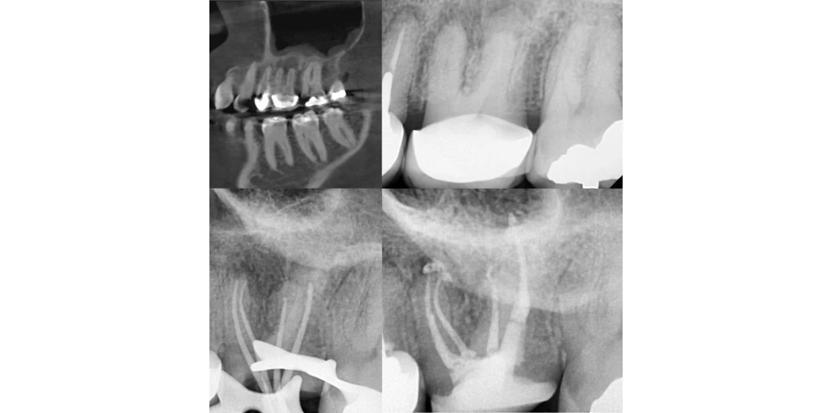 Le docteur Demetriou, endodontiste exclusif à Baisieux : cas cliniques