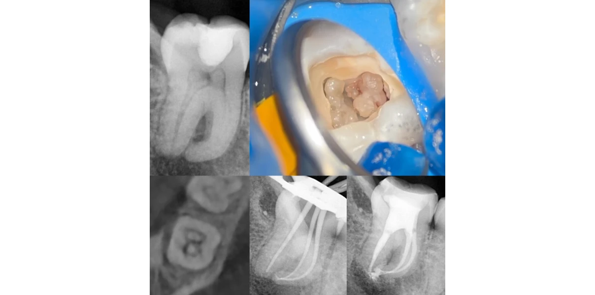 Cas cliniques au Cabinet d’endodontie du Dr Demetriou, endodontiste à Baisieux 59780