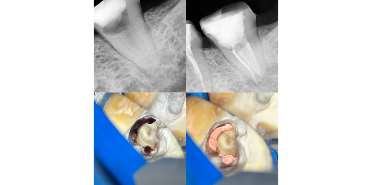 Cas cliniques au Cabinet d’endodontie du Dr Demetriou, endodontiste à Baisieux 59780