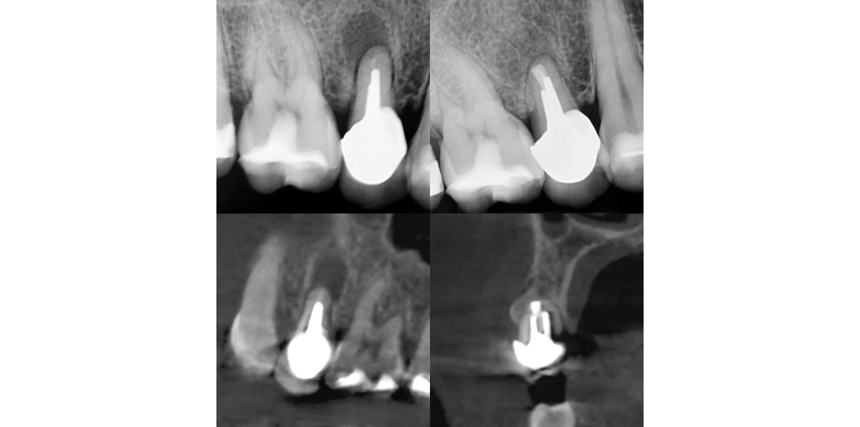 Cas cliniques au Cabinet d’endodontie du Dr Demetriou, endodontiste à Baisieux 59780