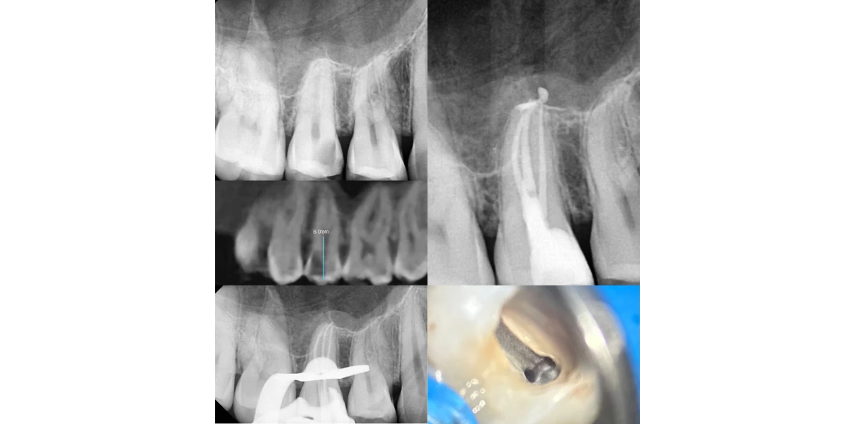 Le docteur Demetriou, endodontiste exclusif à Baisieux : cas cliniques